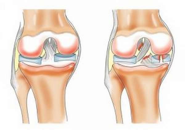 Почему болят колени после тренировки?